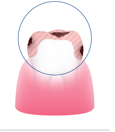 보철 수복의 일반적 삭제 영역