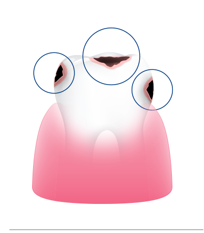 레진빌드업의 병소 중심 접근 삭제 영역